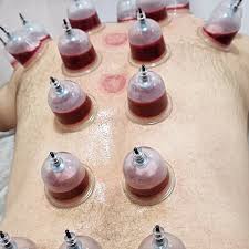 Cupping therapy(Blood,fire,Dry)